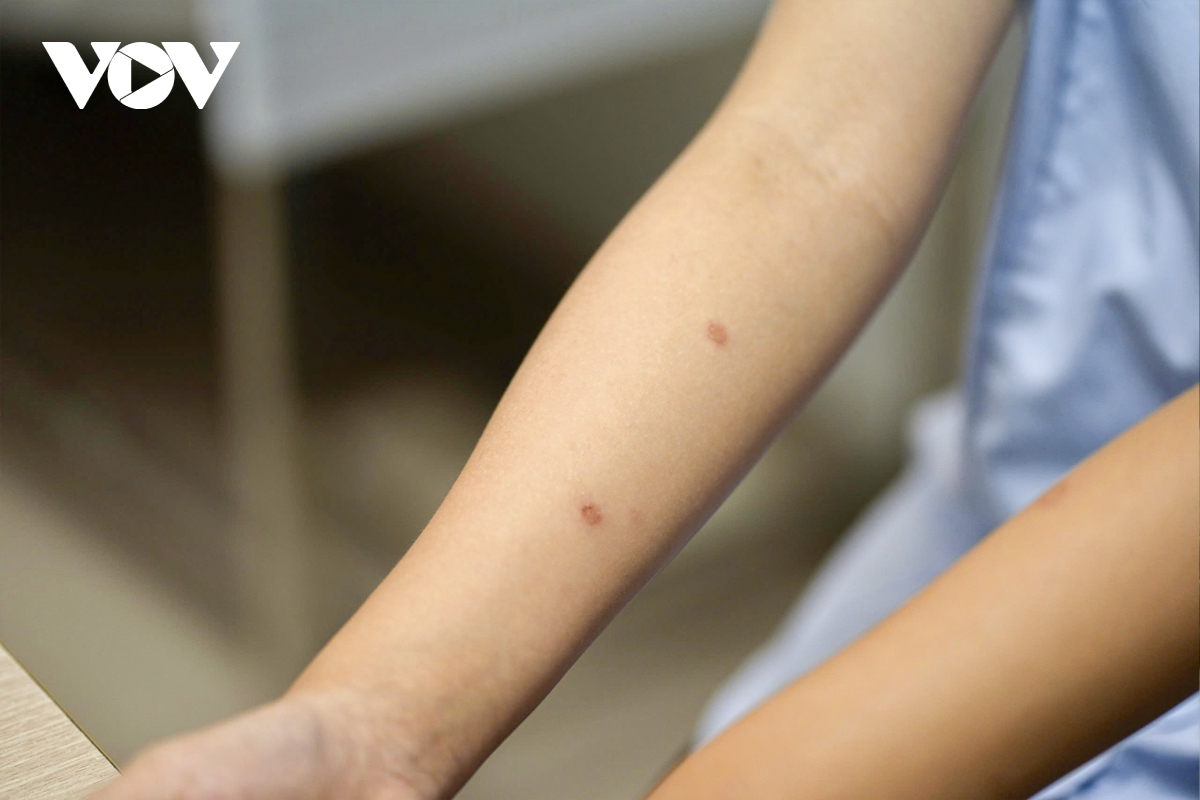 Ôm mèo mỗi ngày, bé gái 14 tuổi trả giá vì nấm da lan rộng